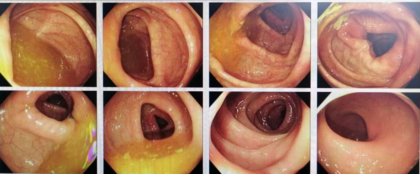 上图为患者的肠镜图像，提示直结肠粘膜未见明显的异常。