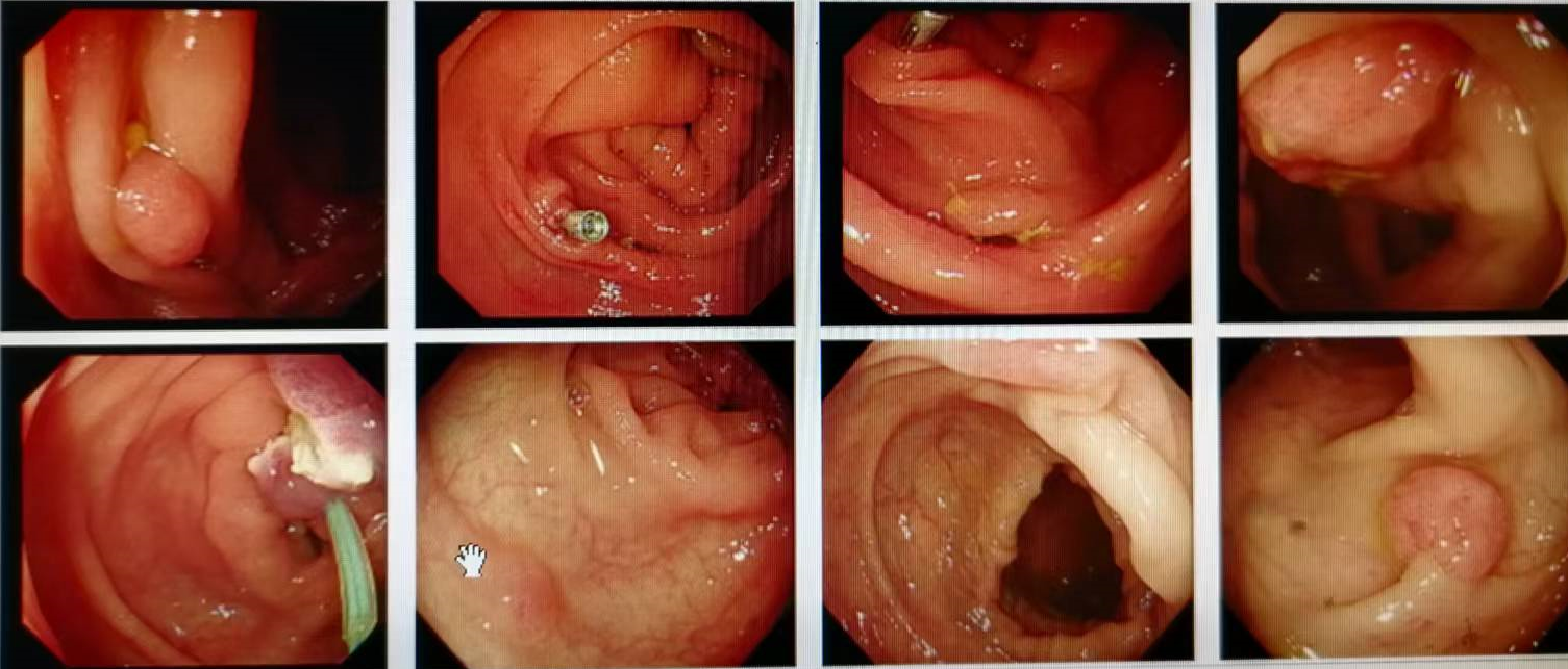 上图为患者的肠镜图像，提示为内镜下肠息肉电凝电切术+金属夹夹闭术