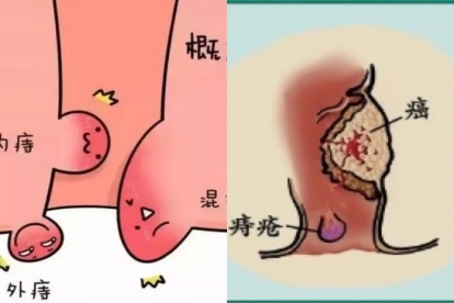 肛门癌和痔疮的区别图片