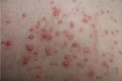 肛周毛囊炎图片