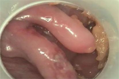 肛门纤维瘤图片