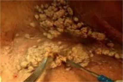 肛门尖锐湿疣图片