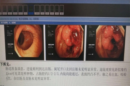 直肠癌菜花状图片
