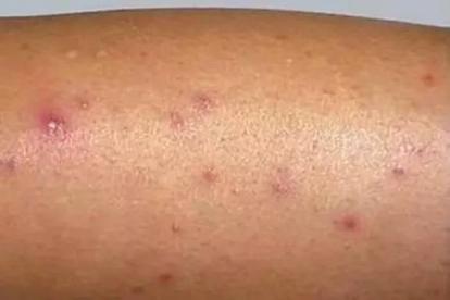 肛门毛囊炎图片