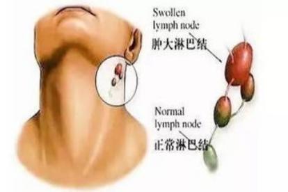 淋巴结肿大图片