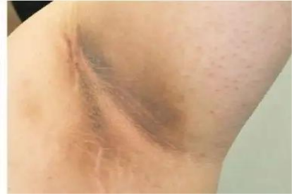 良性黑棘皮病图片