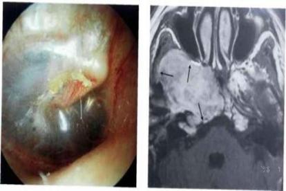中耳癌的早期症状图片