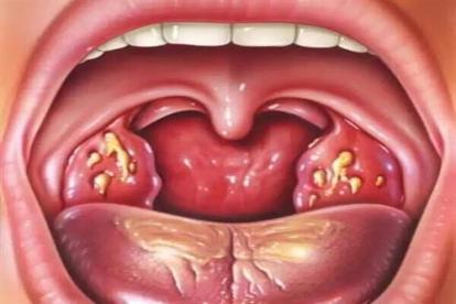 反流性咽喉炎图片