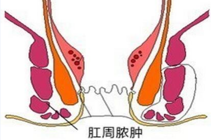肛周脓肿图片