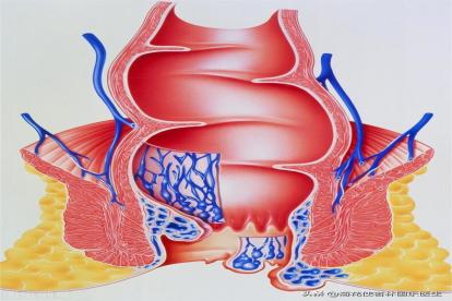 痔疮图片