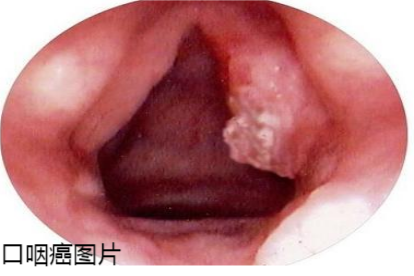 口咽癌