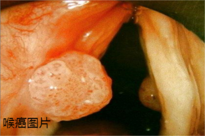 喉癌图片