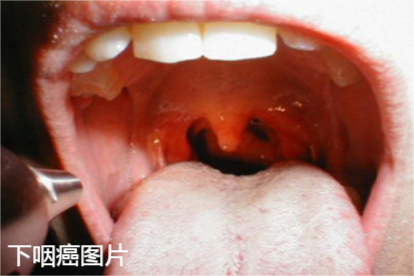 下咽癌图片