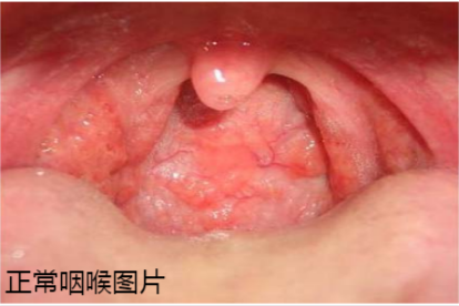 正常咽喉图片