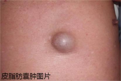 皮脂肪囊肿图片