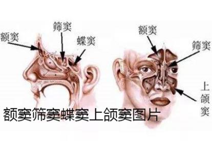 (额窦筛窦蝶窦上颌窦图片