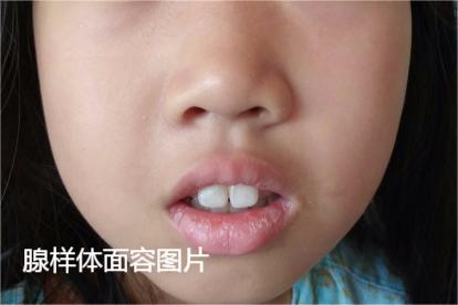 腺样体面容图片