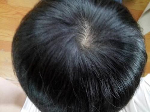 正常人的头顶头发密度
