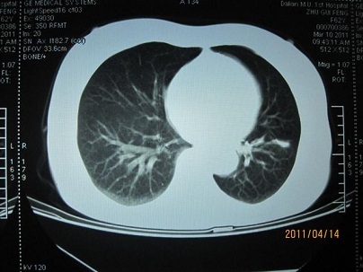 有炎症的肺部ct图片