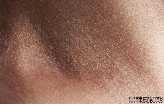 轻微黑棘皮初期图