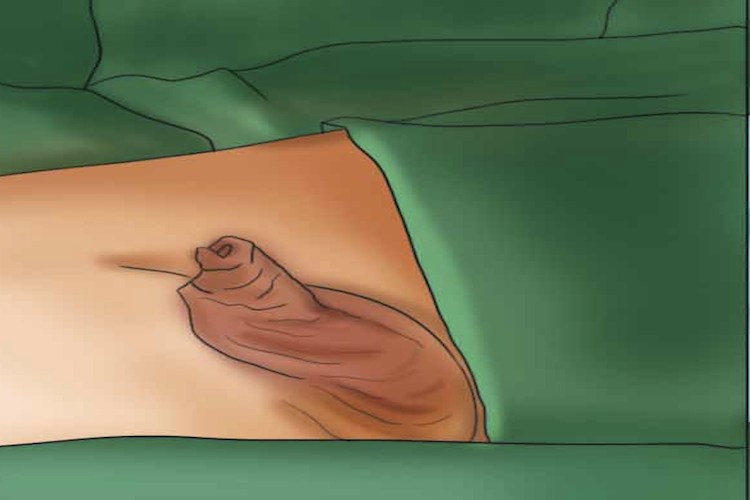 婴儿隐匿性阴茎图