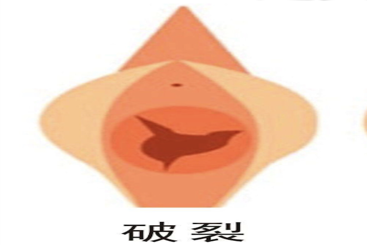 处女膜破裂图