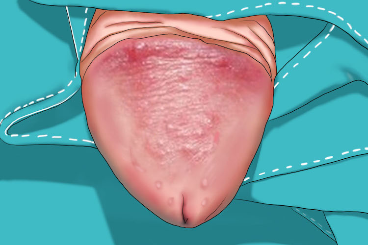 浆细胞性包皮龟头炎图